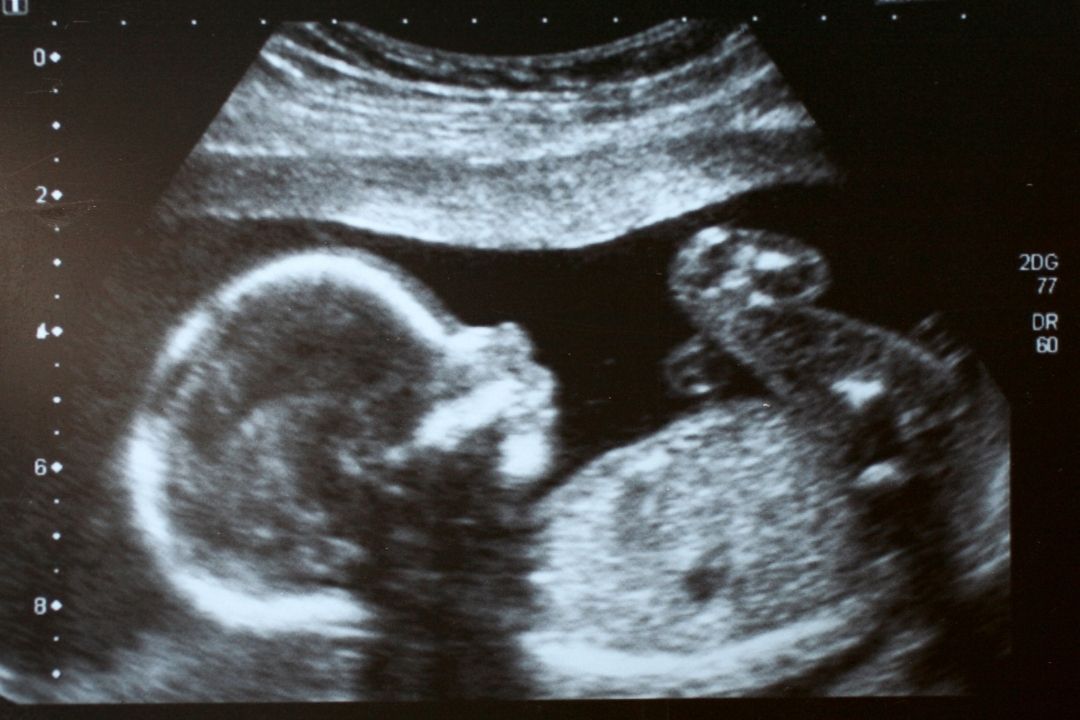 aborto